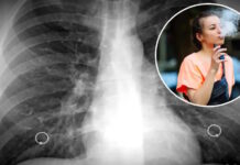 Se confirma que el vape provoca una enfermedad pulmonar rara e irreversible
