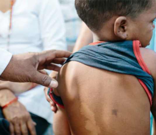 La provincia de Salta registra 11 casos de lepra