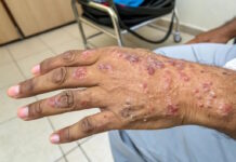 La provincia de Salta registra 11 casos de lepra