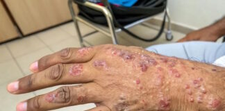 La provincia de Salta registra 11 casos de lepra